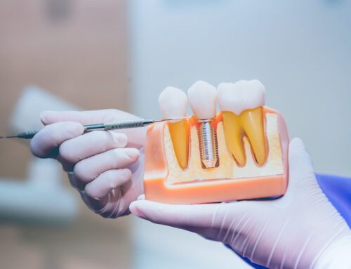 Replacing a Missing Tooth: Bridge vs Dental Implant in Montreal