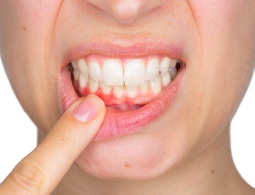 Gingivitis vs Periodontitis: When Bleeding Gums Become Serious in Montreal