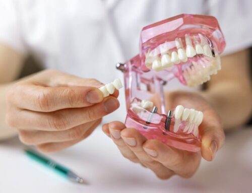 Dental Implants in Montreal: The Long-Lasting Solution for Replacing a Tooth